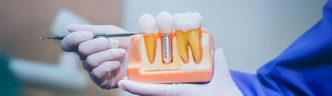 Dental Implant Specialist in Newnan GA